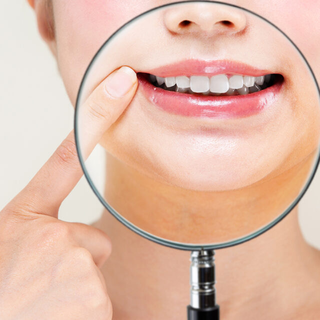 ホワイトニング