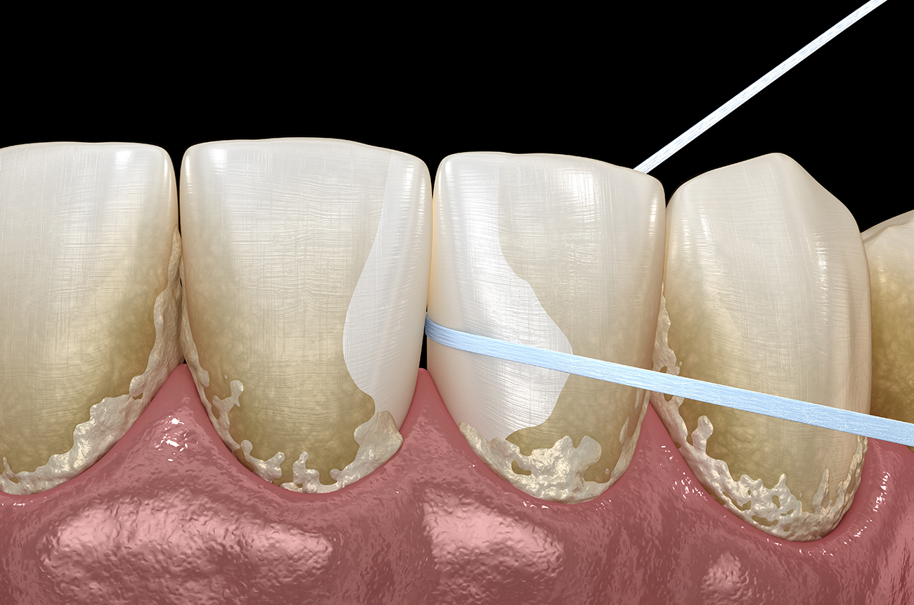 デンタルフロス
