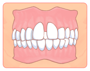 空隙歯列