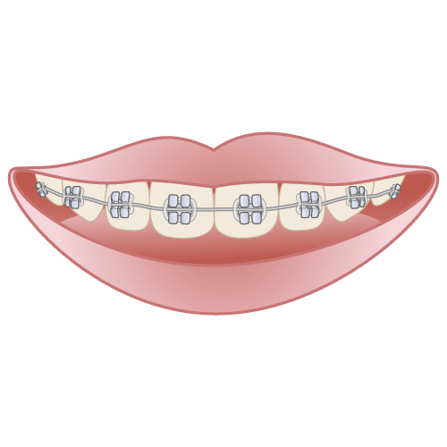 ワイヤー矯正（固定式ブラケット）