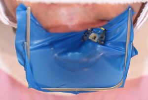 ラバーダム防湿