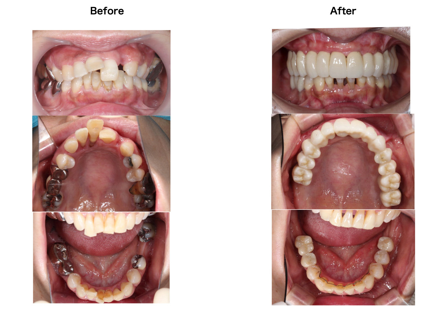 ボロボロの歯の治療症例
