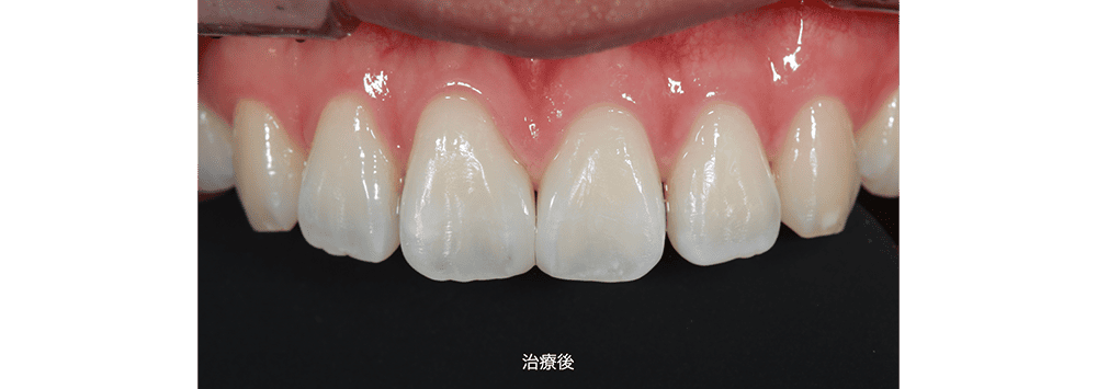 症例2 治療後