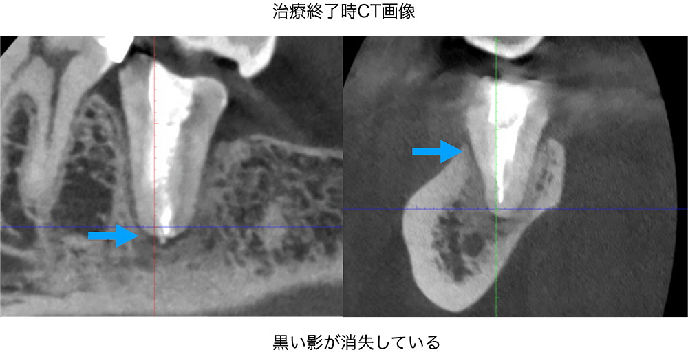 精密根管治療症例1（治療後）