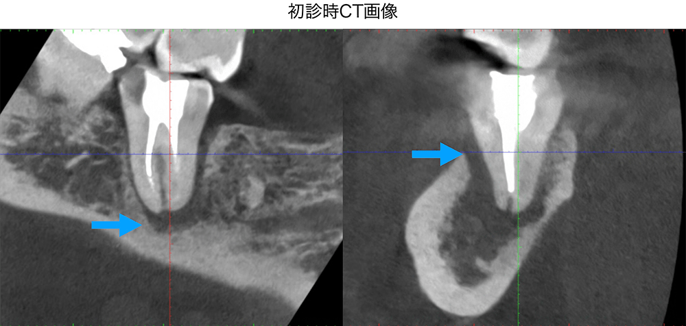 精密根管治療症例1（治療前）