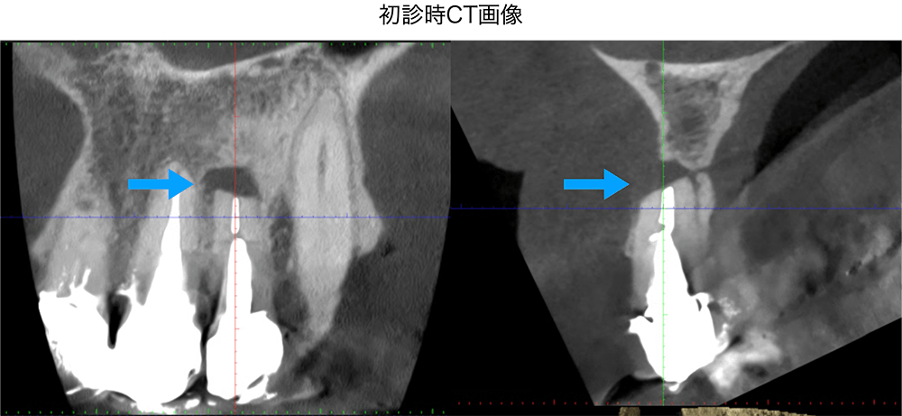 症例3 治療前・治療中