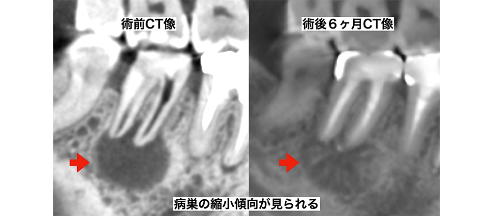 症例4 治療比較