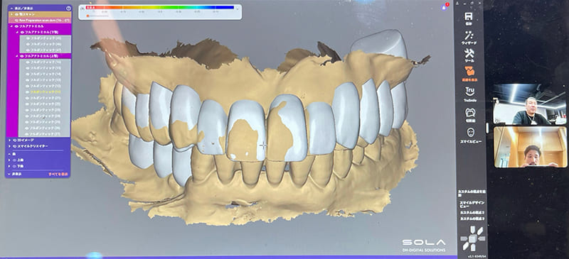 審美治療シミュレーション画像